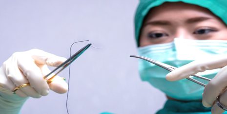 Chỉ phẫu thuật tự tiêu là gì? Các loại chỉ phẫu thuật tự tiêu phổ biến hiện nay